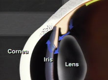 glaucoma_ang._abierto_1